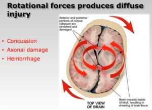 John Lloyd motorcycle helmet expert rotational brain injury